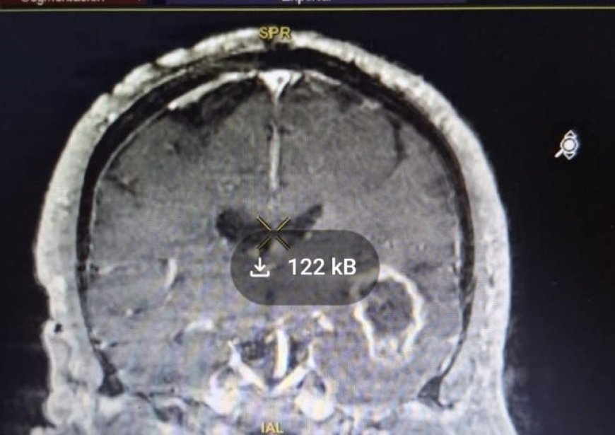 Casmu realizó primera cirugía de tumor cerebral con fluorescencia en Uruguay